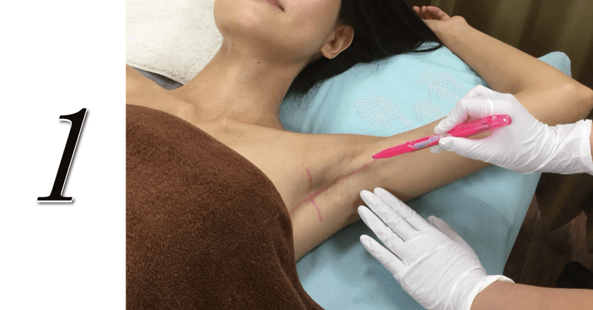 医療レーザー脱毛施術の流れその1