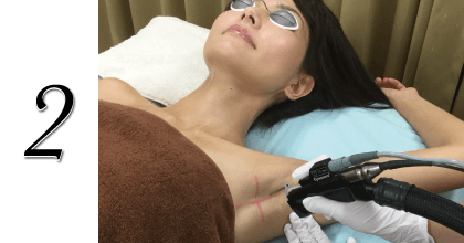 医療レーザー脱毛　施術の流れその1